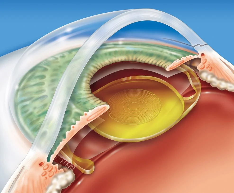 Vou fazer a cirurgia de catarata: quais os pontos importantes ao escolher a lente intraocular? image